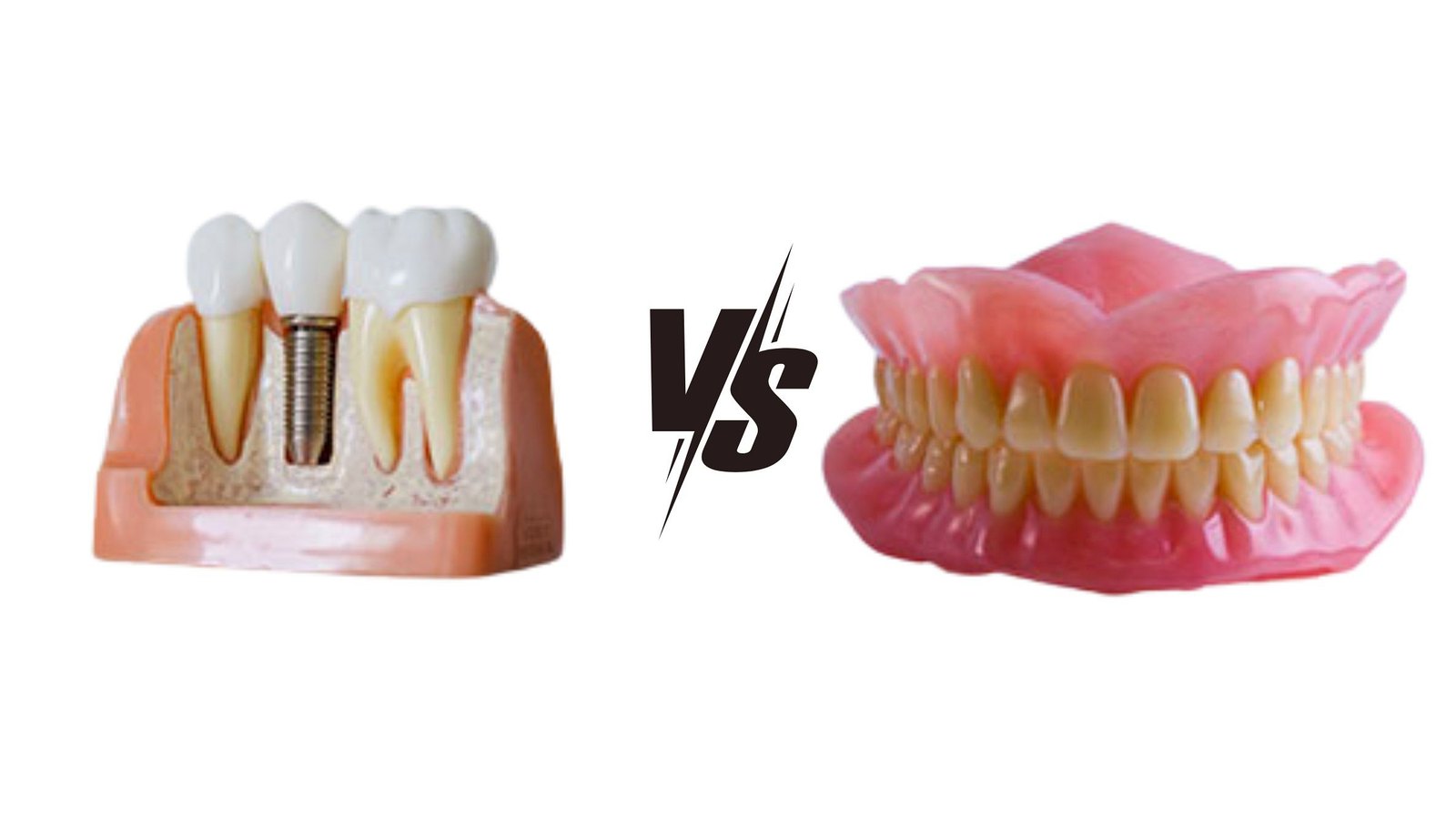 Dental implants vs dentures — which is right for you?