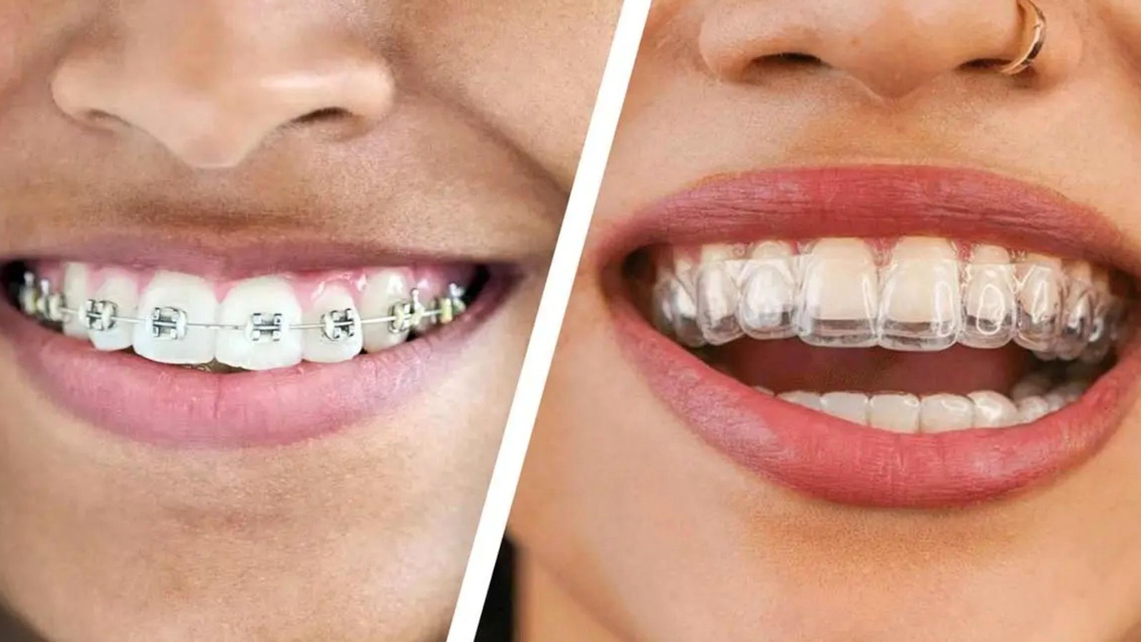 Braces or clear aligners — a modern comparison