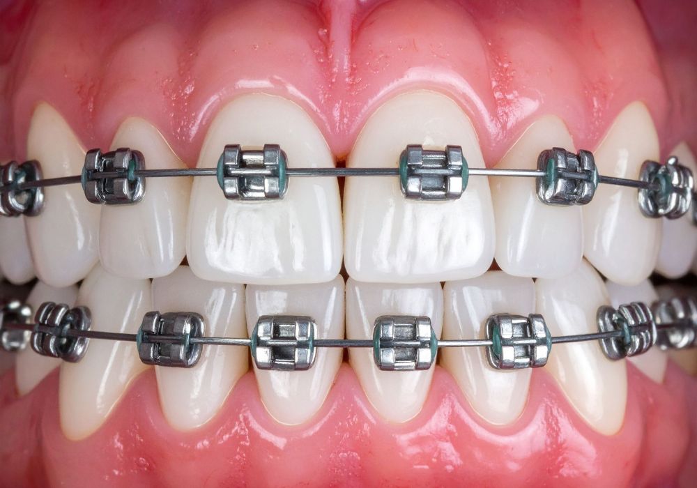 Braces & Orthodontics at Kolkata Smiles Dental Clinic, Dum Dum, Kolkata
