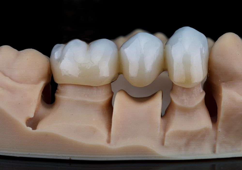Dental Crowns & Bridges at Kolkata Smiles Dental Clinic, Dum Dum, Kolkata