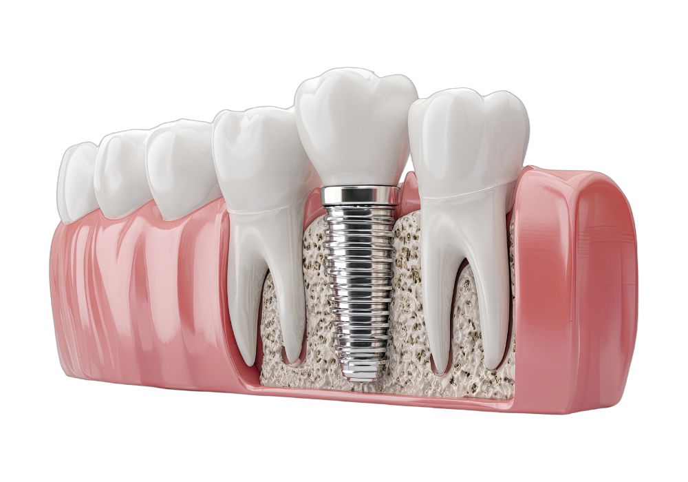 Dental Implants at Kolkata Smiles Dental Clinic, Dum Dum, Kolkata