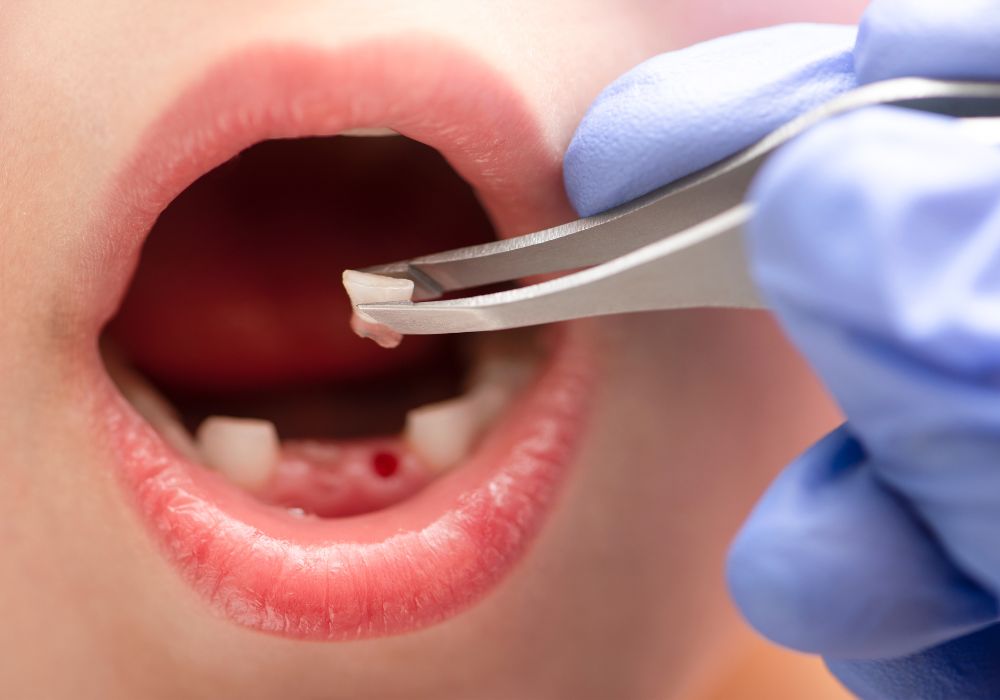 Tooth Extraction at Kolkata Smiles Dental Clinic, Dum Dum, Kolkata
