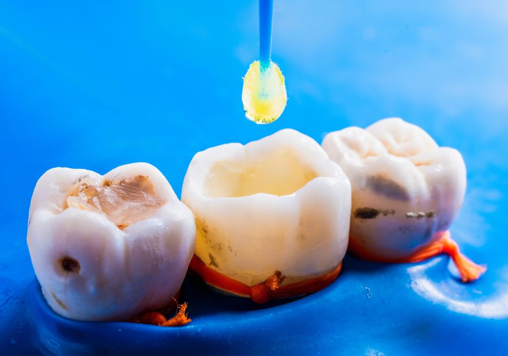 Dental Fillings at Kolkata Smiles Dental Clinic, Dum Dum, Kolkata