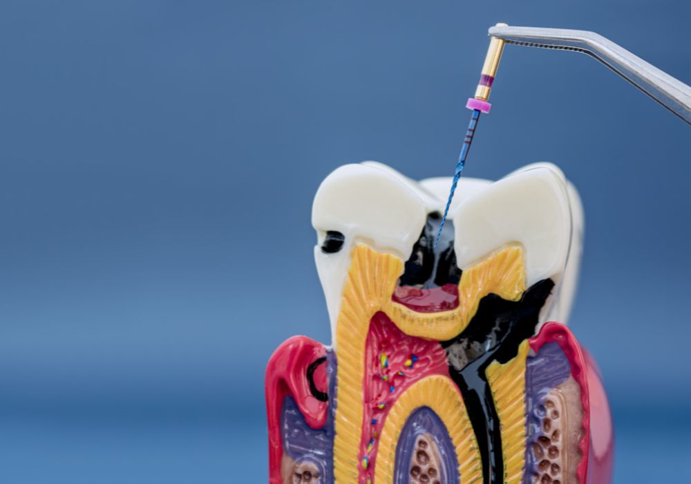Root Canal Treatment at Kolkata Smiles Dental Clinic, Dum Dum, Kolkata