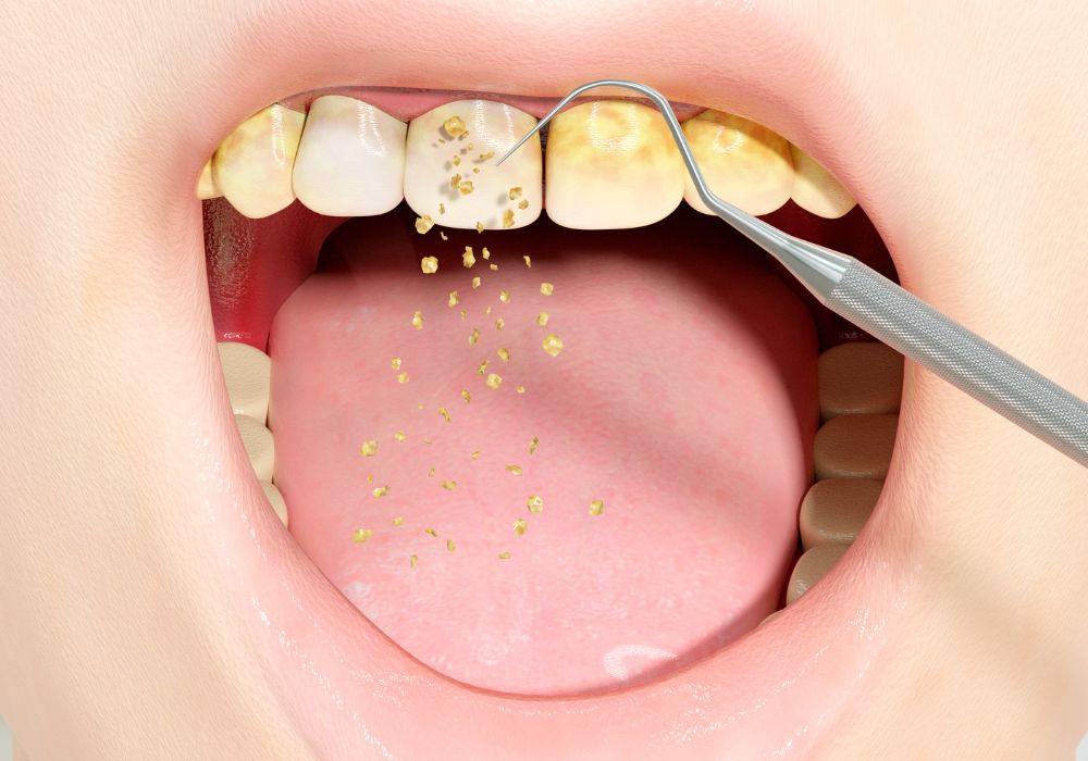 Scaling & Polishing at Kolkata Smiles Dental Clinic, Dum Dum, Kolkata