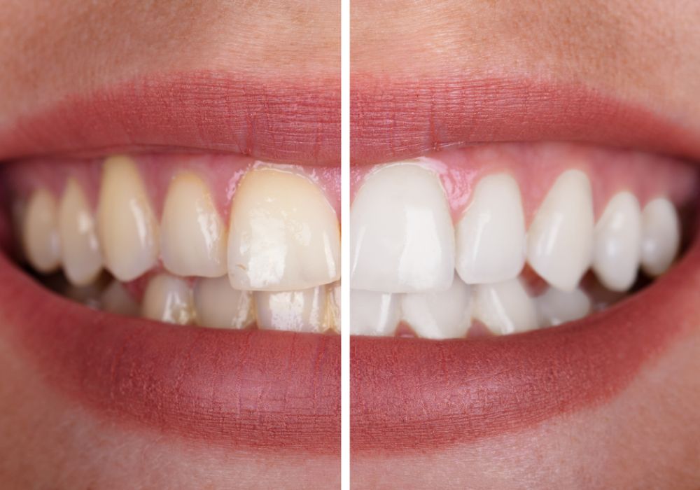 Teeth Whitening at Kolkata Smiles Dental Clinic, Dum Dum, Kolkata
