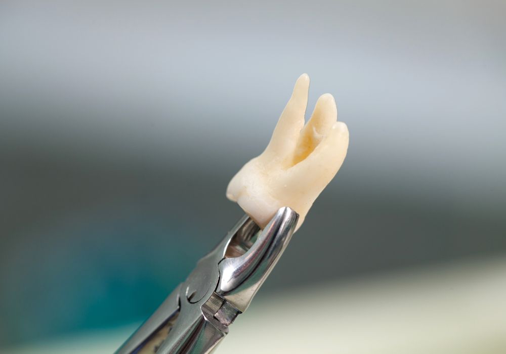 Wisdom Tooth Removal at Kolkata Smiles Dental Clinic, Dum Dum, Kolkata